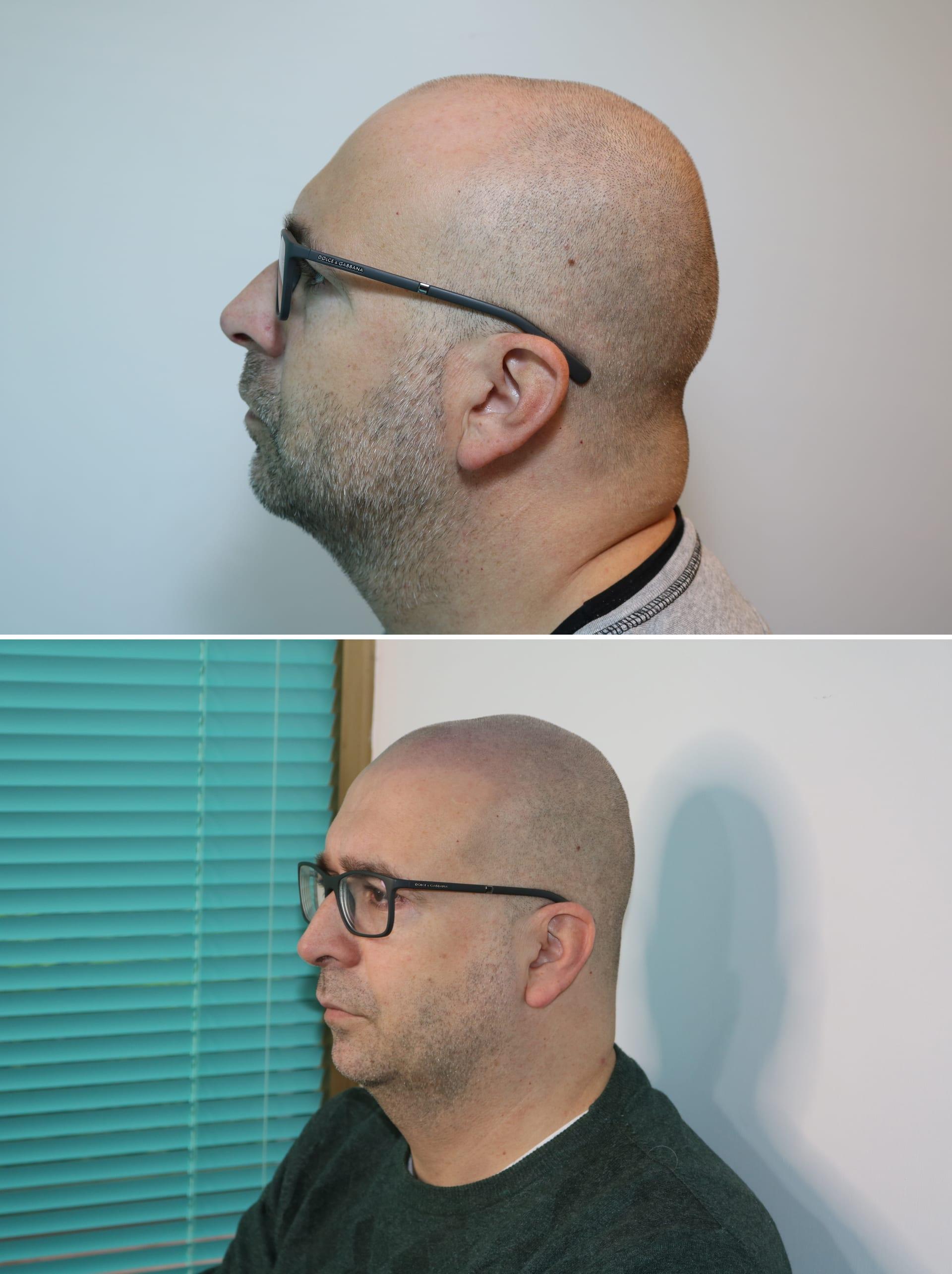 Tricopigmentazione, prima e dopo, caso #69, Firenze
